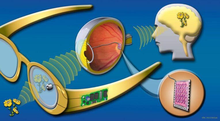 Bionic Eyes Diagram of one type of bionic eye
